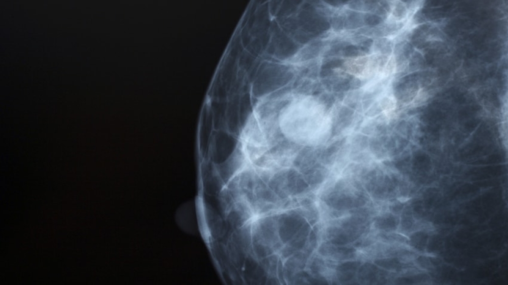 Ultrasound of dense breast tissue