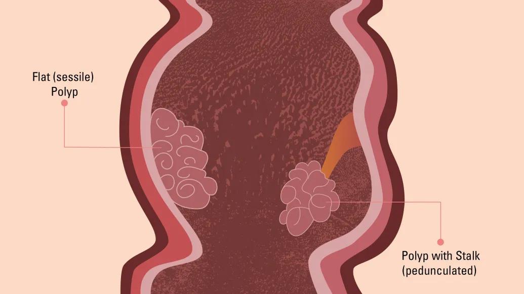 Graphic depicting sessile and pedunculated colon polyps