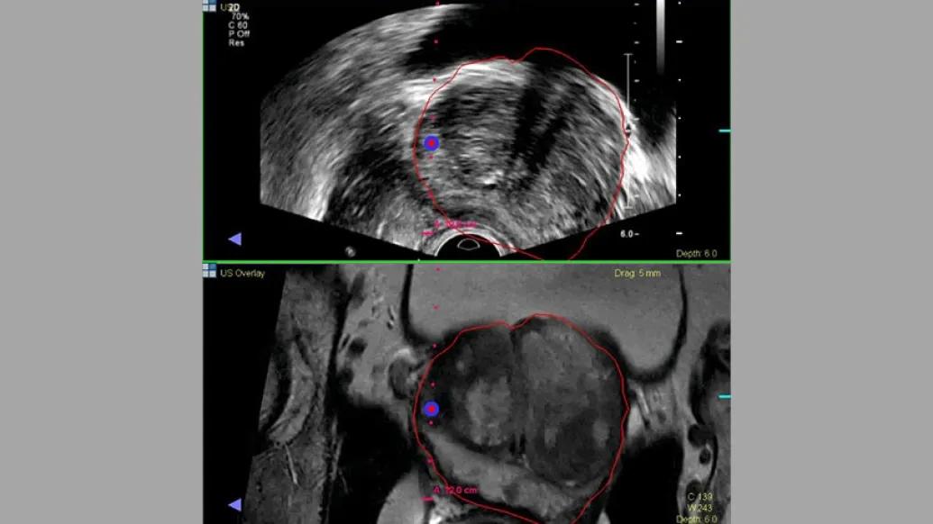Prostate Cancer Biopsy
