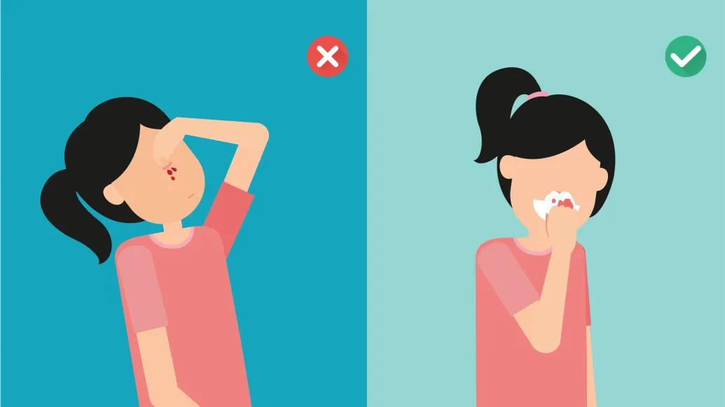To stop a bloody nose, lean forward, not backward.