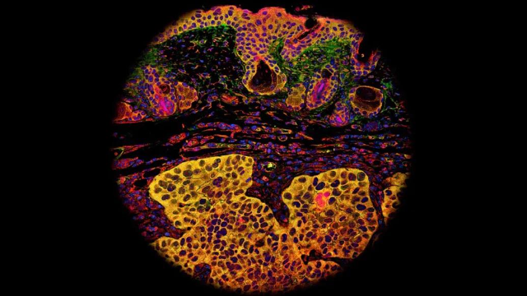 Details of a cancer tumor cell under the microscope