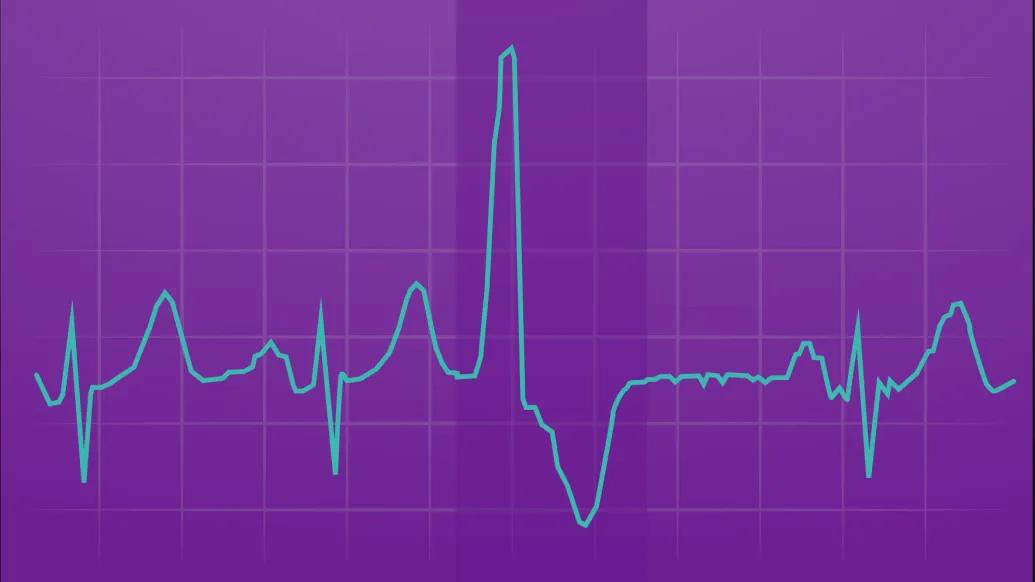 Illustration of an EKG printout showing premature ventricular contractions