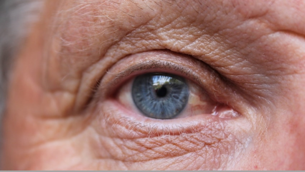 Close up of an eye suffering from wet age related macular degeneration (wet AMD)