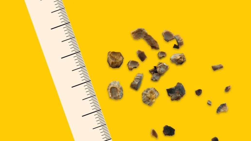 A collection of large kidney stones