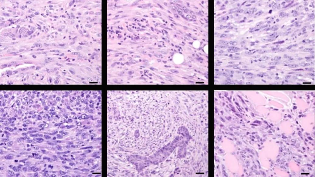 Microscopic images of metaplastic breast cancer cells