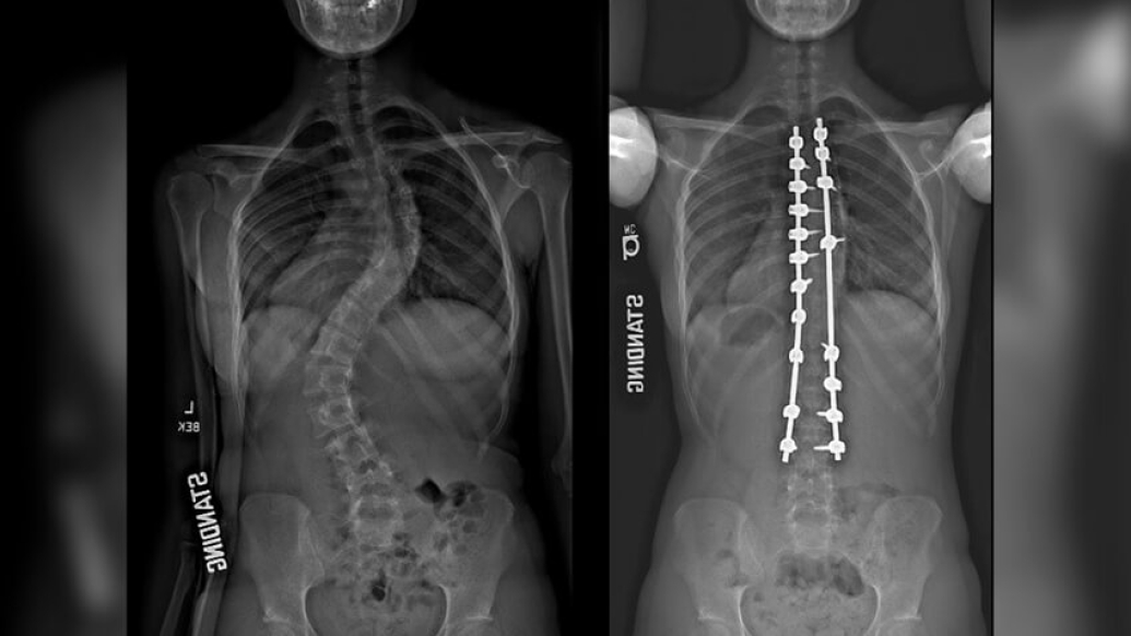 Xray image comparison of spine.