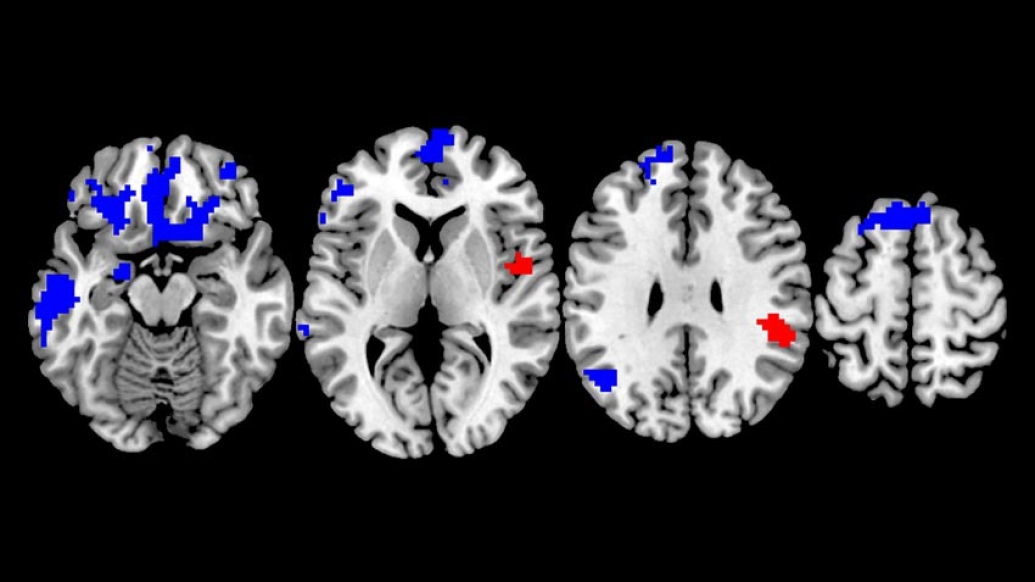 Brain scans of OCD.