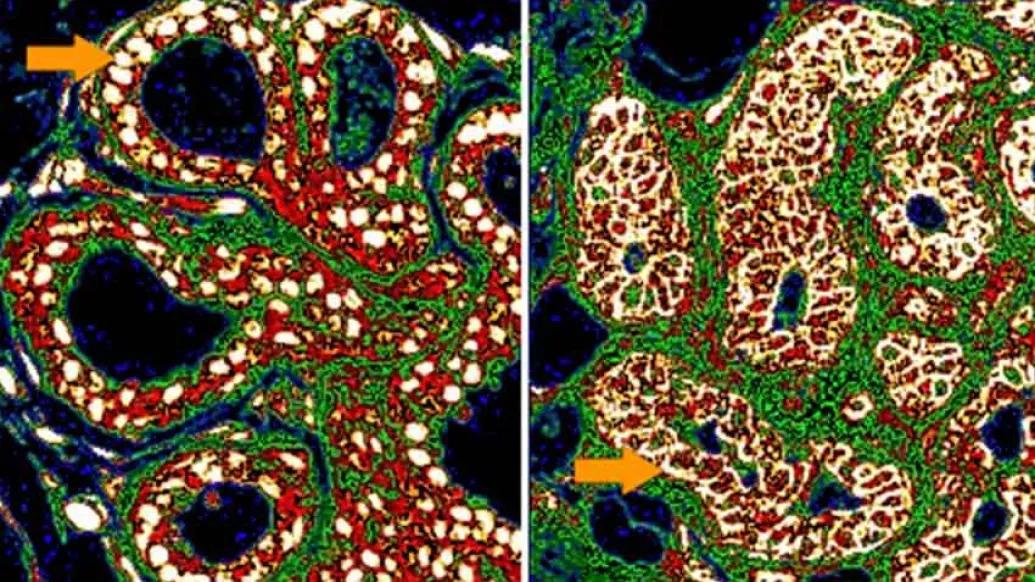 close up of breast cancer cell scan