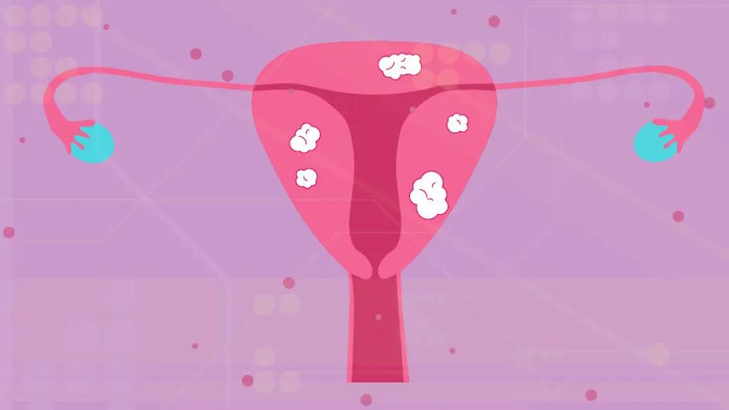 drawing of pink uterus with white fibroid spots on a light purple background