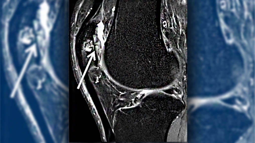 Ultrasound image of knee sag cartilage