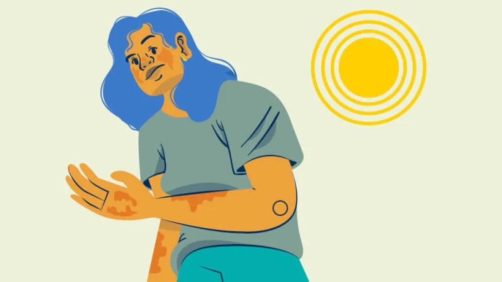 Person standing in the sun in blue with skin rash