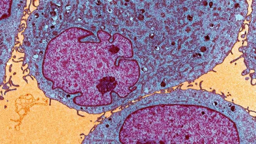 Leukemia_and_lymphoma_tumor_cells