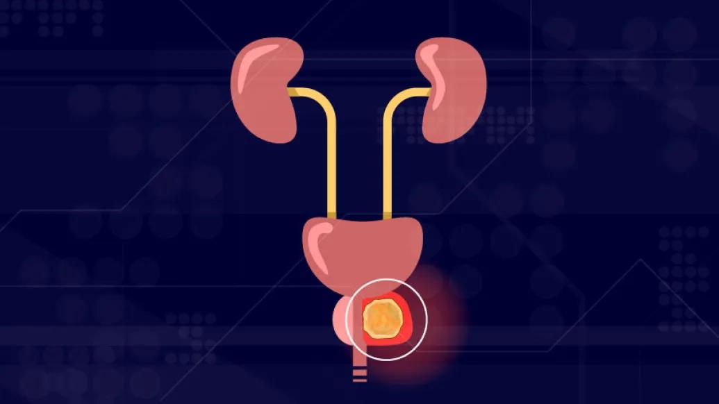 Prostate cancer