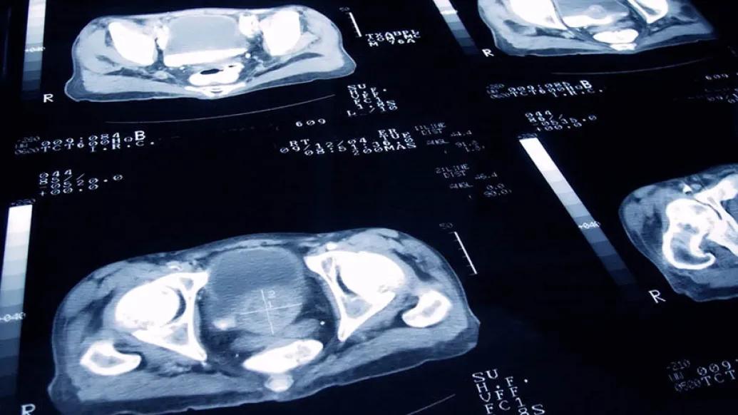 Prostate cancer scans