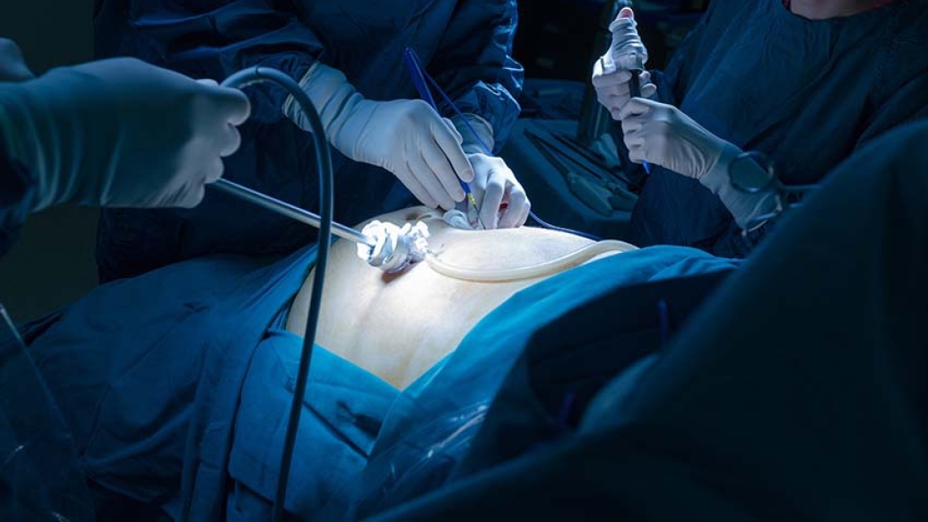 image of surgery happening above stomach with blue surgical drapes with surgical tools with white gloves removing appendix