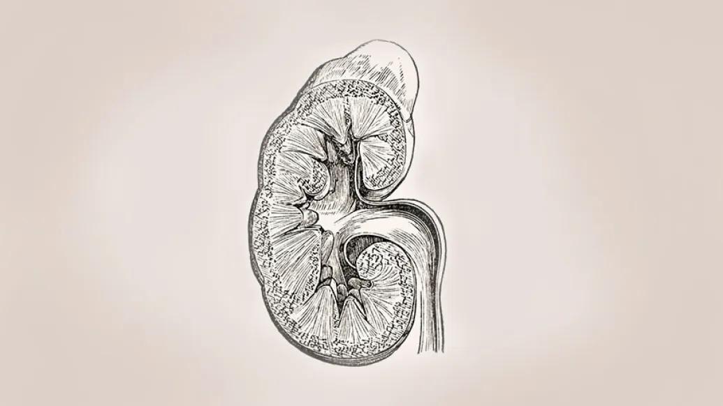 Illustration of a a kidney with lupus nephritis