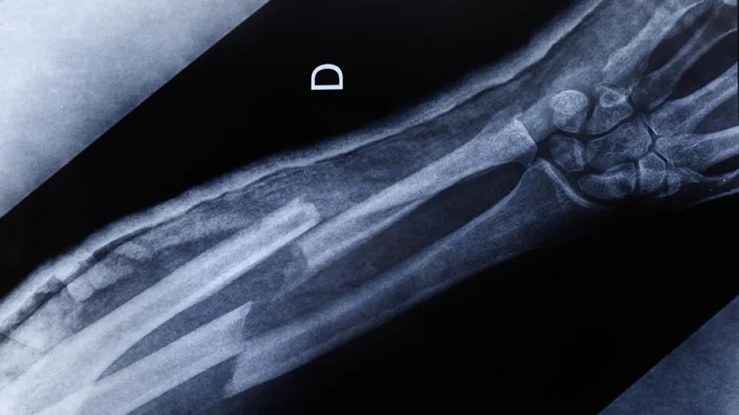 Xray of a broken arm
