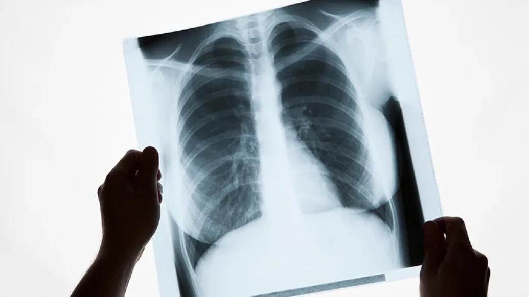 image of x-ray of lungs, two hands holding it