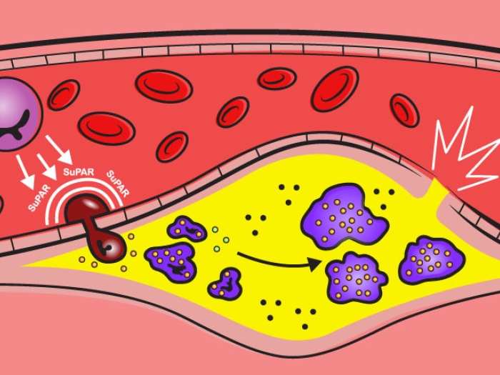 suPAR cells enter the blood vessel wall and accelerate the development of atherosclerosis