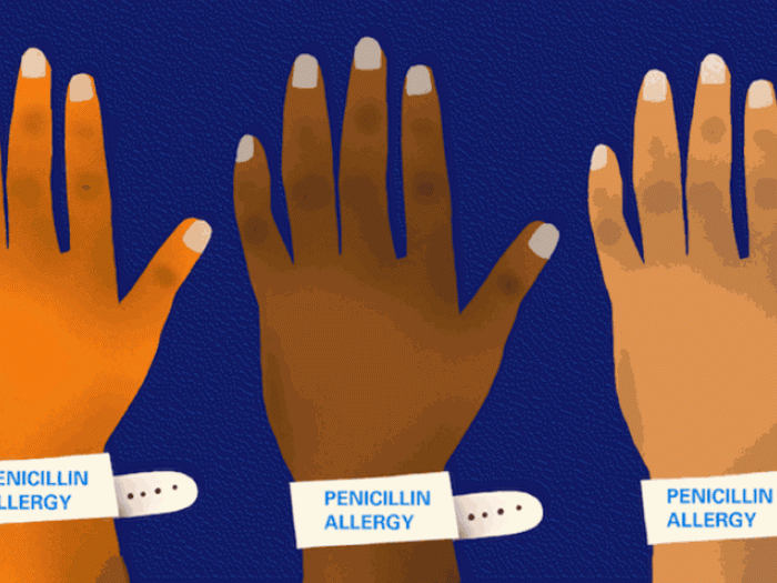 Three hands with two medical bands having the words penicillin allergy disappearing. 