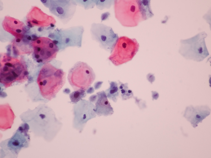 A microscopic image of an infection shown from a Pap test