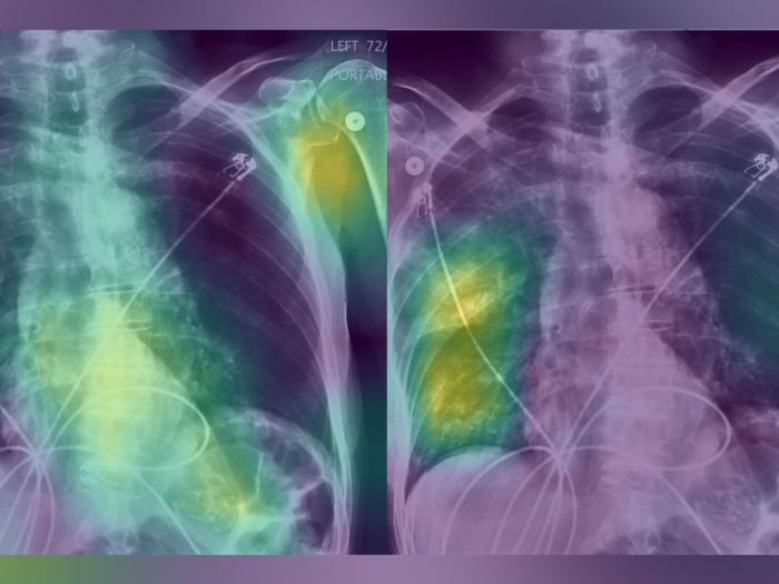 x-ray rib lung purple