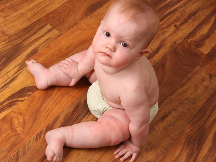 Eczema