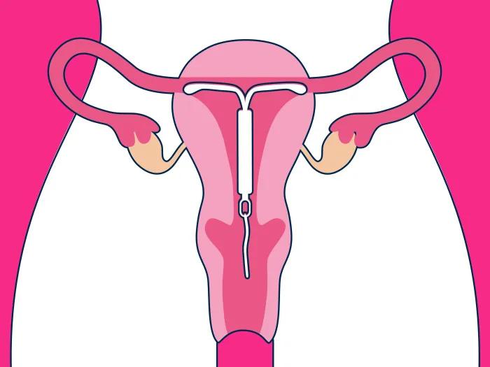 uterus pink background white body outline seeing white IUD