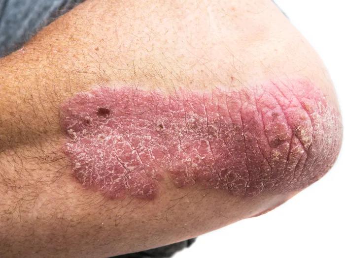 red rash on elbow