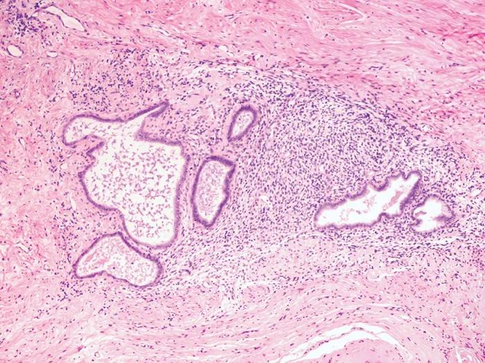 Microscopic section of endometriosis that has been dyed pink. 