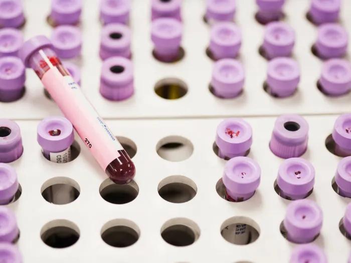 lab tests purple tops