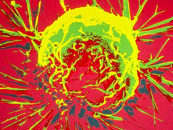 Breast cancer cell