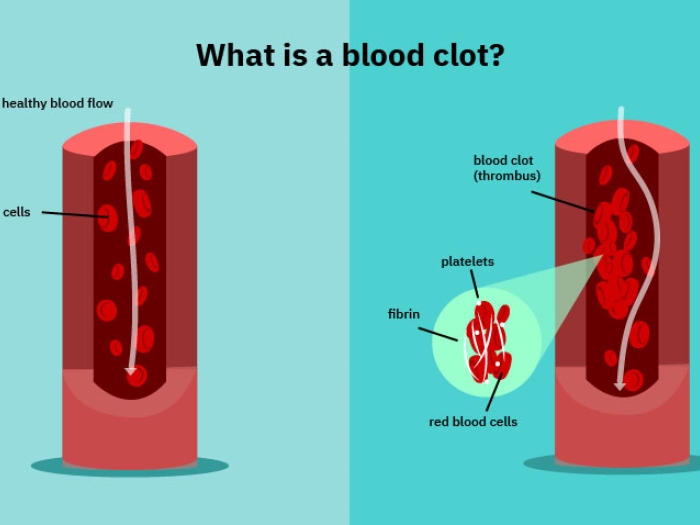 What is a blood clot image, illustrating healthy blood flow, red blood cells, blood clots, platelets, fibrin and red blood cells  