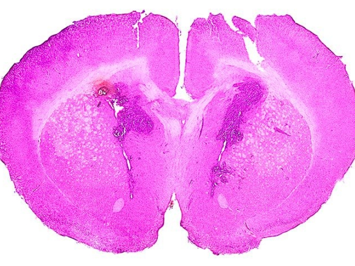 pink brain cross section pink tumor