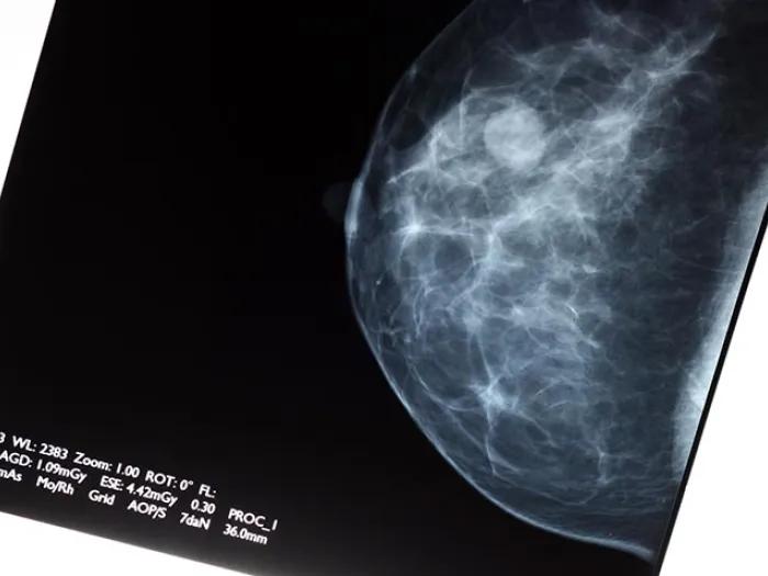 Breast cancer scan image