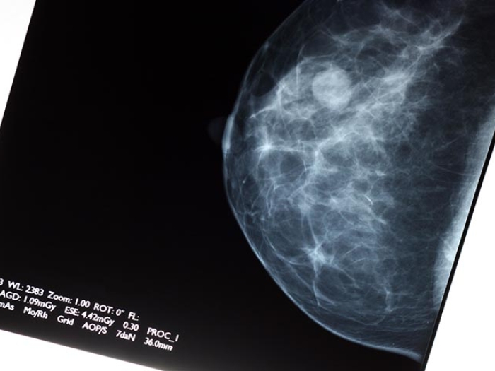 Breast cancer scan image