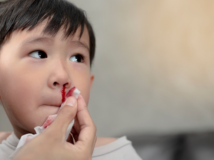 child nose bleeding blood tissue
