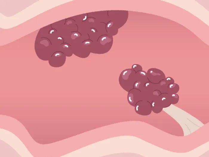 colon interior polyps in stomach lining drawing