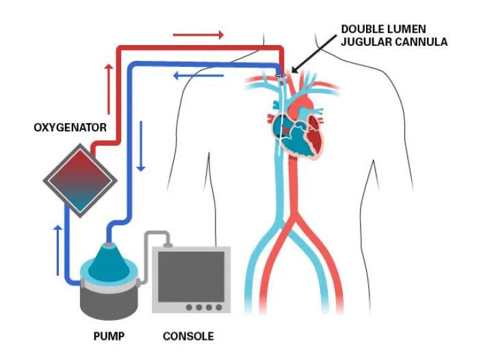oxygenator, pump, console, double lumen jugular cannula diagram of ECMO