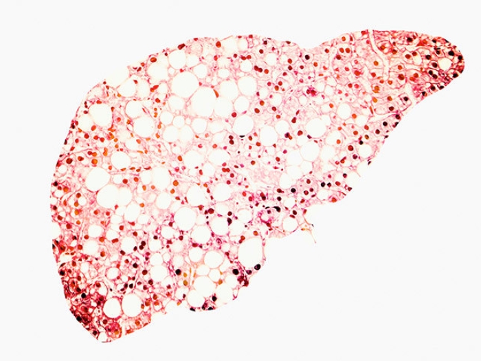 fatty liver red dye white image