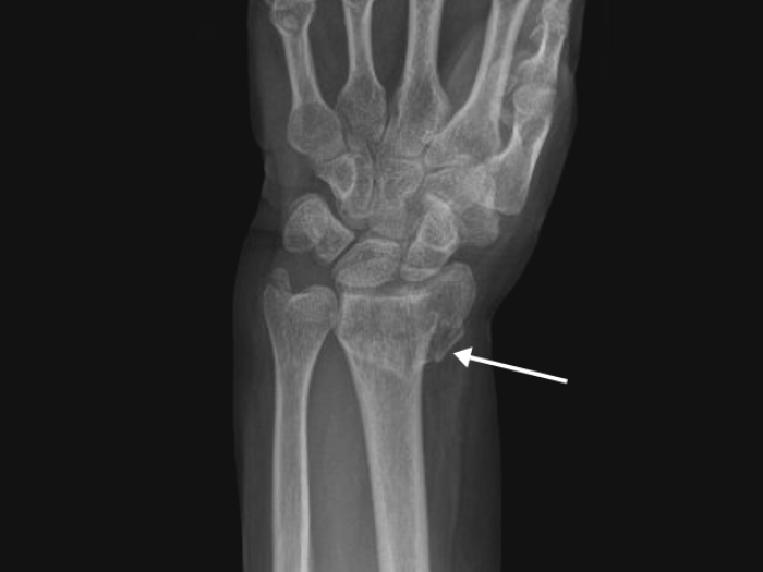 forearm wrist bone fracture with arrow pointing to it on xray
