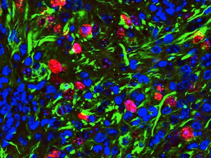 Glioma scientific rendering cancer cells