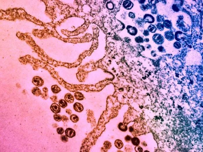 HIV attacking cells in purple pink and red
