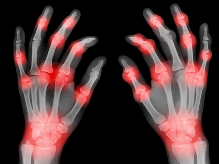 hands of xray finfers with red spots