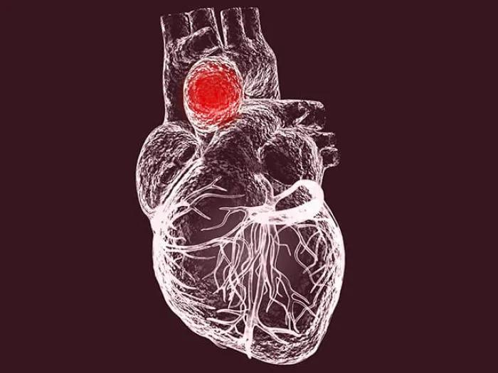 Heart model aneurysm aorta veins
