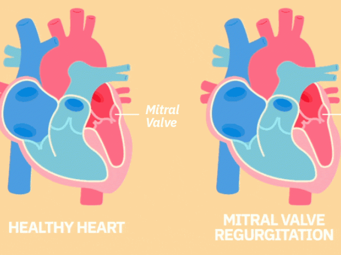 gif of a healthy heart pumping and a mitral valve regurgitation