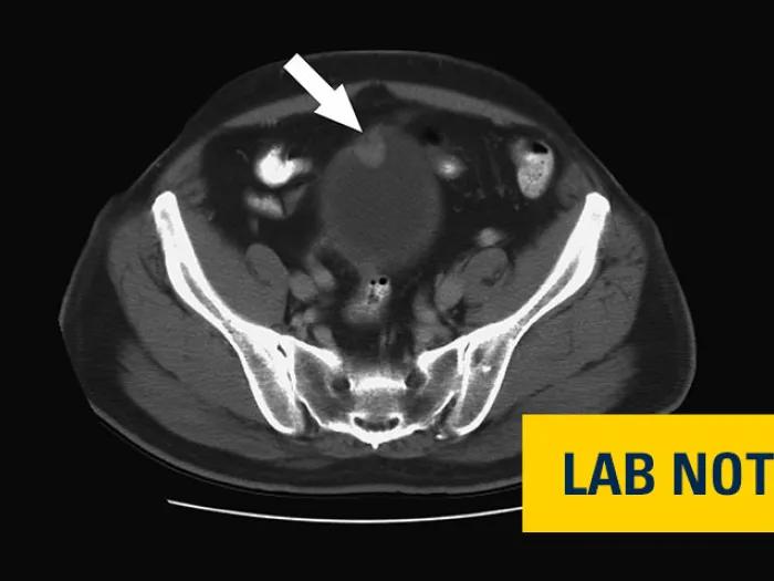 image of a bladder scan