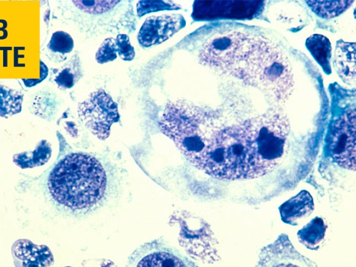 lymphoma microscopic cells image blue