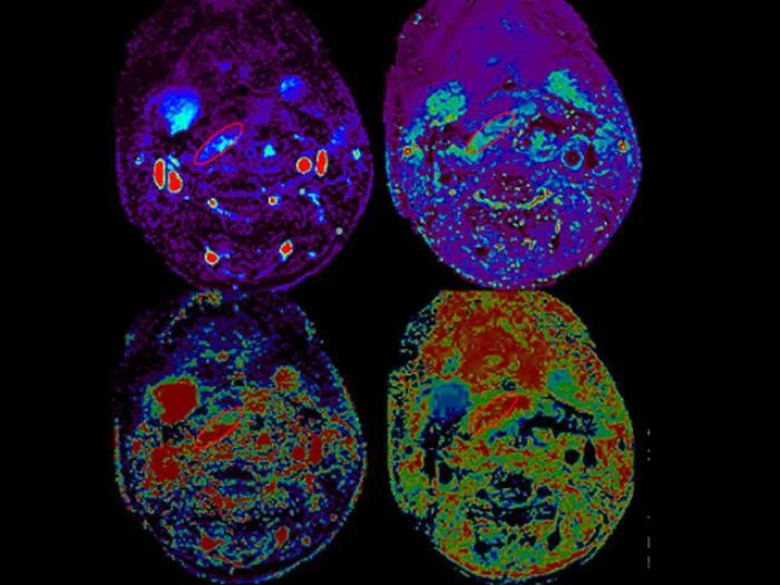 MRI perfusion flap scan highlight