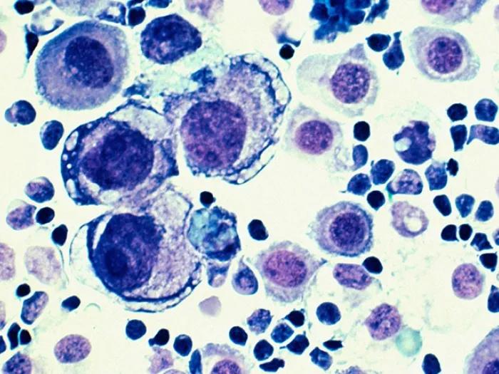 Image of purple and blue colored cells of metastatic breast cancer.